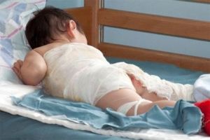 Сэрэмжлүүлэг: Халуун тогоонд ”чанагдсан” хүүхдийн тоо өссөөр байна