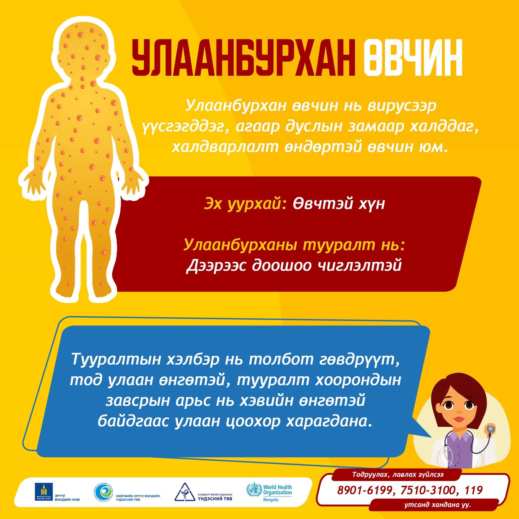 Улаанбурхан өвчин нь халдварлалт өндөртэй ч вакцинаар сэргийлэгдэх боломжтой халдварт өвчин юм