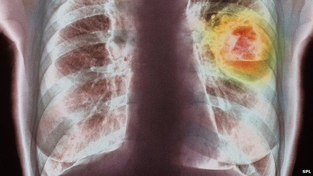 _71693146_m1340336-coloured_x-ray_showing_lung_cancer-spl _71693146_m1340336-coloured_x-ray_showing_lung_cancer-spl