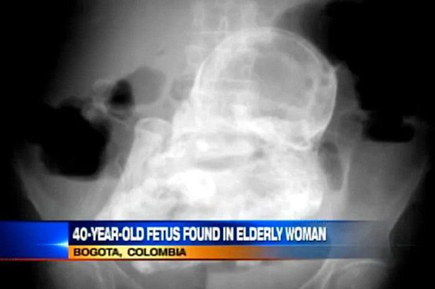 foetus-has-been-found-inside-the-body-3138096