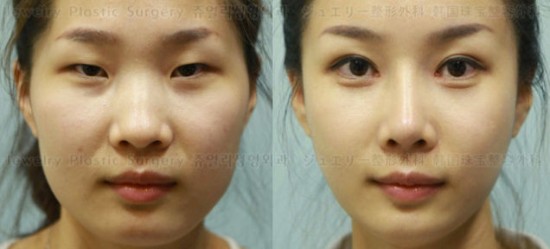 Korea-plastic-surgery-550x249