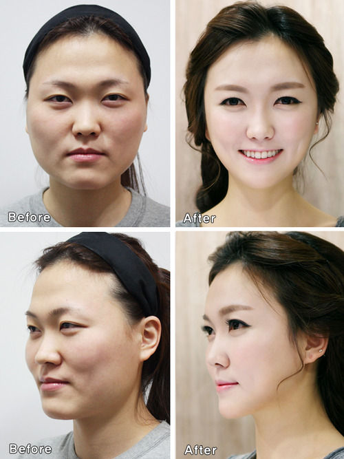 Korea-plastic-surgery3 (2)