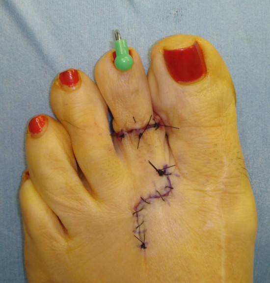 cinderella-surgery3-550x577