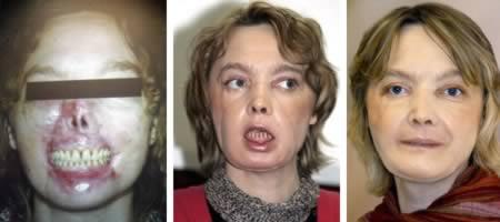 a98383_face-transplant_1-most-extensive
