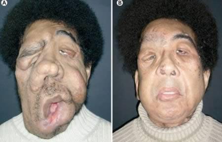 a98383_face-transplant_1-most-extensive