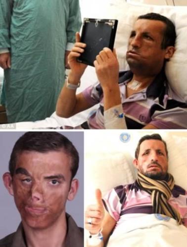 a98383_face-transplant_1-most-extensive