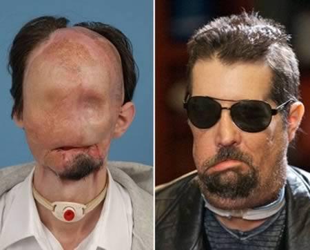 a98383_face-transplant_1-most-extensive