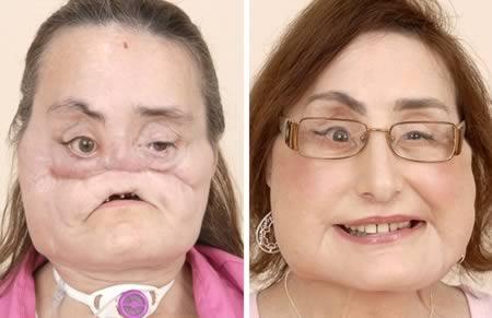 a98383_face-transplant_1-most-extensive