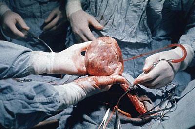 donor heart