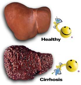 complications-cirrhosis
