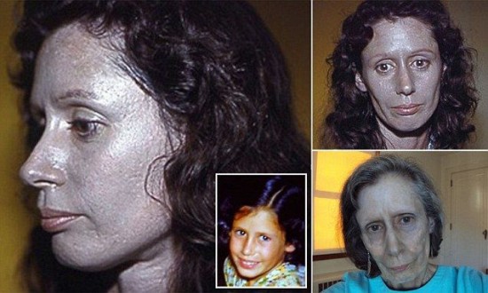 Rosemary-Jacobs-argyria-550x330