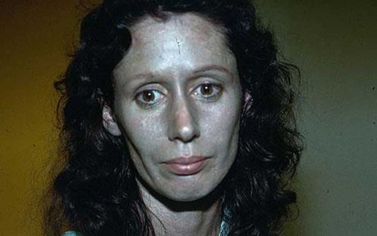 Rosemary-Jacobs-argyria2-550x344 Rosemary-Jacobs-argyria2-550x344