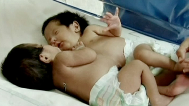 Conjoined-twins-born-atta-016 Conjoined-twins-born-atta-016