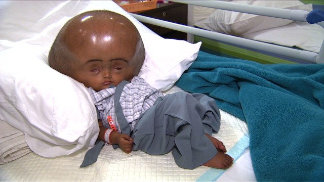 130815014849-india-swollen-baby-1-horizontal-gallery 130815014849-india-swollen-baby-1-horizontal-gallery