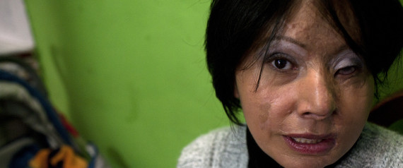 n-ACID-ATTACKS-COLOMBIA-large570 n-ACID-ATTACKS-COLOMBIA-large570