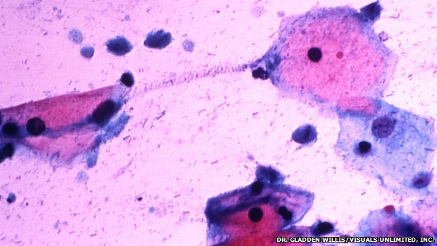 _74956172_trichomonas_vaginalis_in_a_pap_smear-spl-1