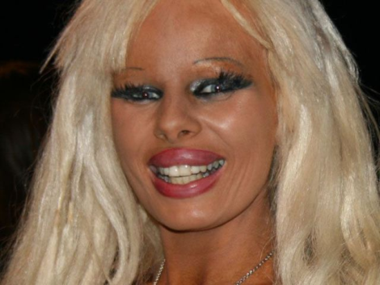 plastic-surgery-fails-0017