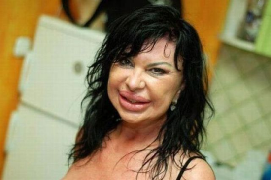 plastic-surgery-fails-0009