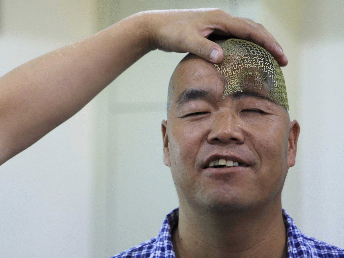 Man_Whose_Head_Was_Crushed-4eba21c7565c52d6f7e1b61744ef009c