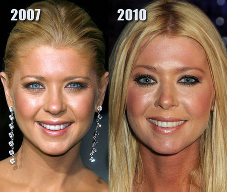 a97834_rsz_geri_halliwell_implants