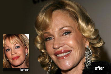 p-celebrity-plastic-surgery-p01